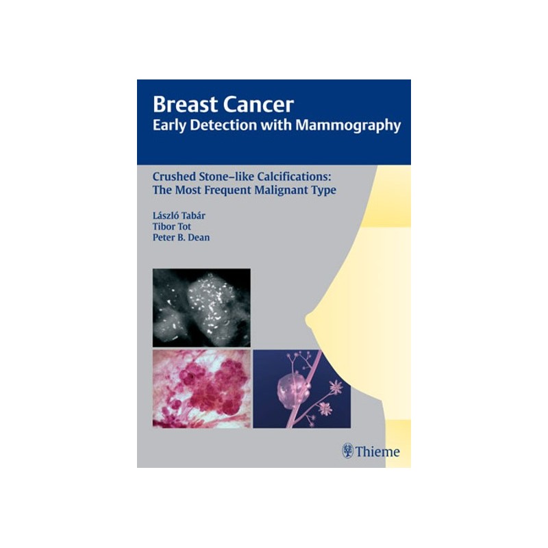 Breast Cancer: Early Detection with Mammography - Crushed Stone-like Calcifications: The Most Frequent Malignant Type